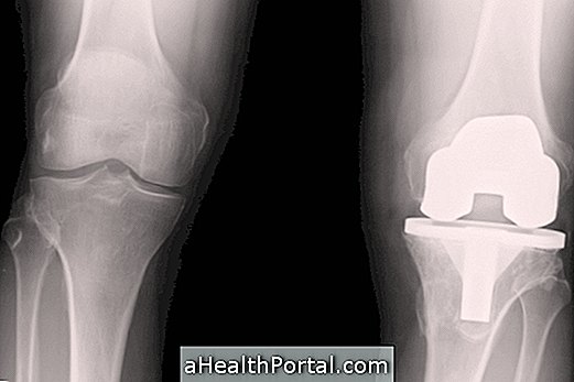 fájdalom a térd artroplasztika után rózsaszínű kis láb artrózis kezelés
